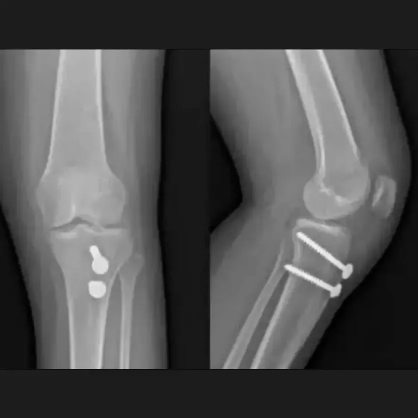 Realineación rotuliana / liberación lateral