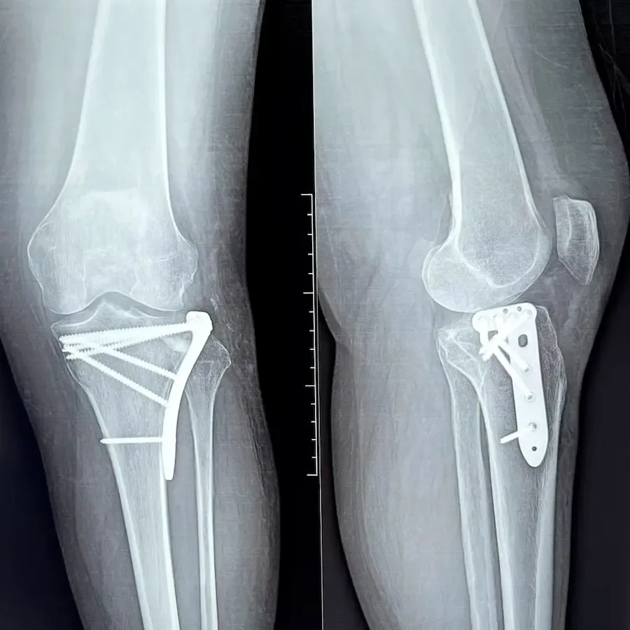 Fijación de fracturas de rodilla