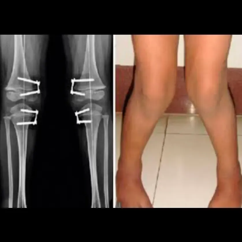 Osteotomía tibial o femoral