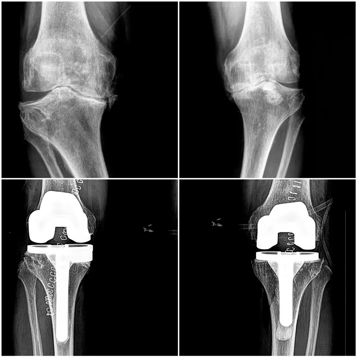 Reemplazo total de rodilla